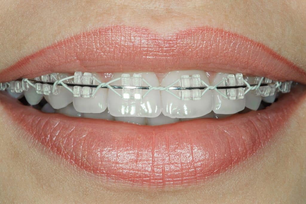 Considering Adult Orthodontic Treatment? What You Should Know