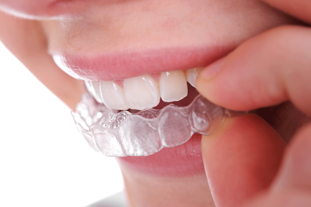 How Long Do You Have To Wear Invisalign?