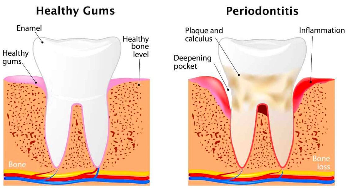 Healthy gums vs periodontitis graphic